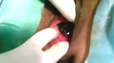 追求刺激妹子到医院取逼里的灯泡 这个难度有点大 不能用工具 几个人用手硬抠出来的 真是进去容易出来难